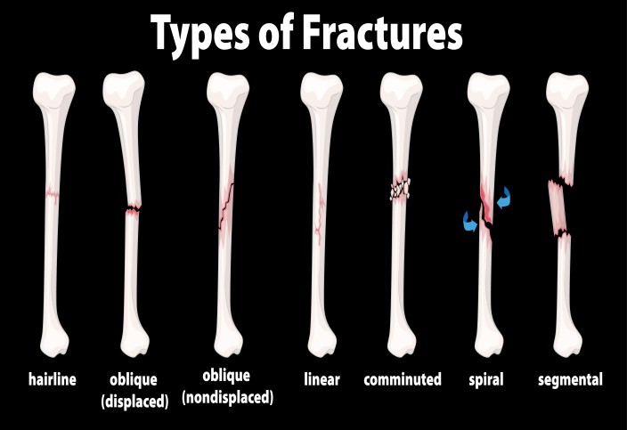 type of bone fracture